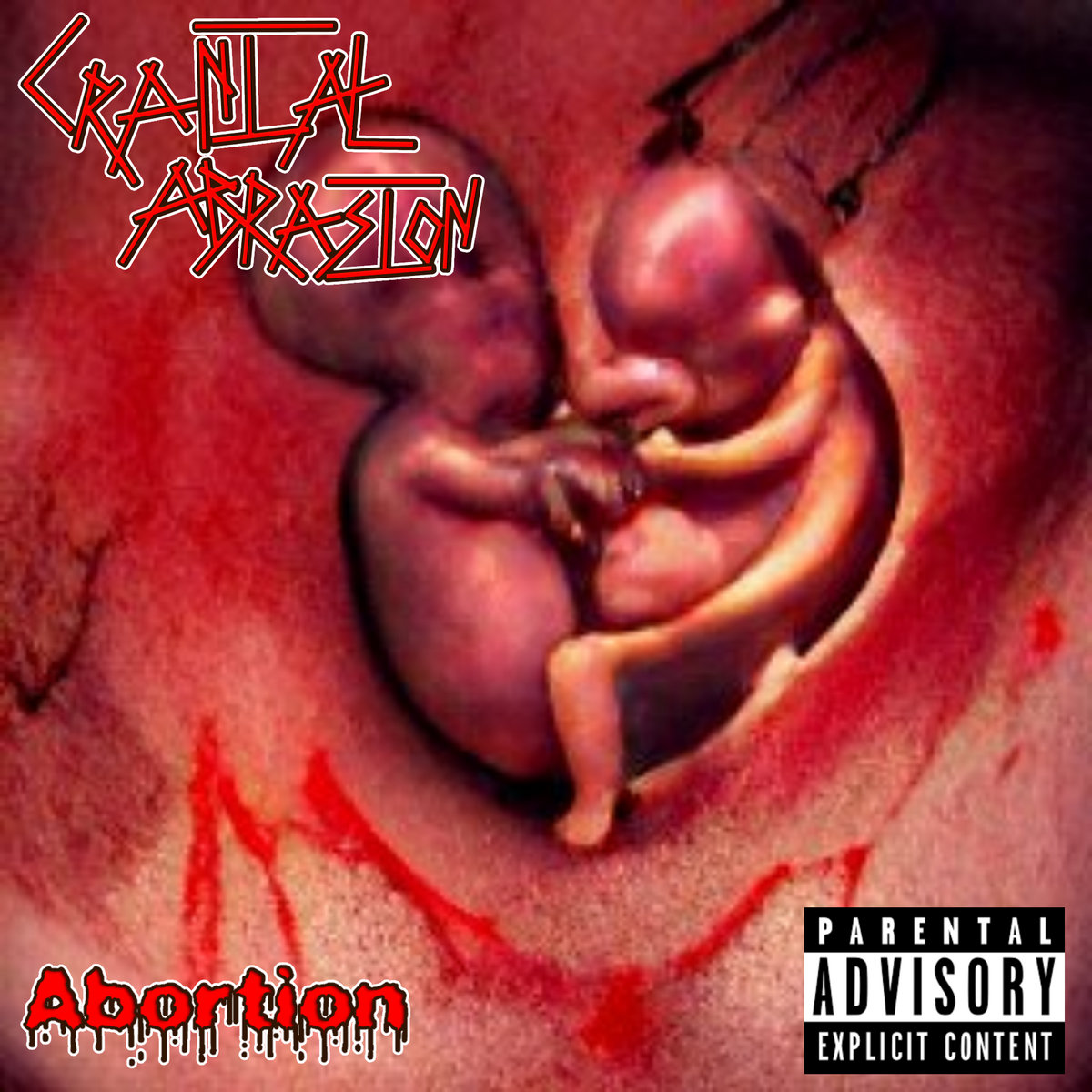 Abortion