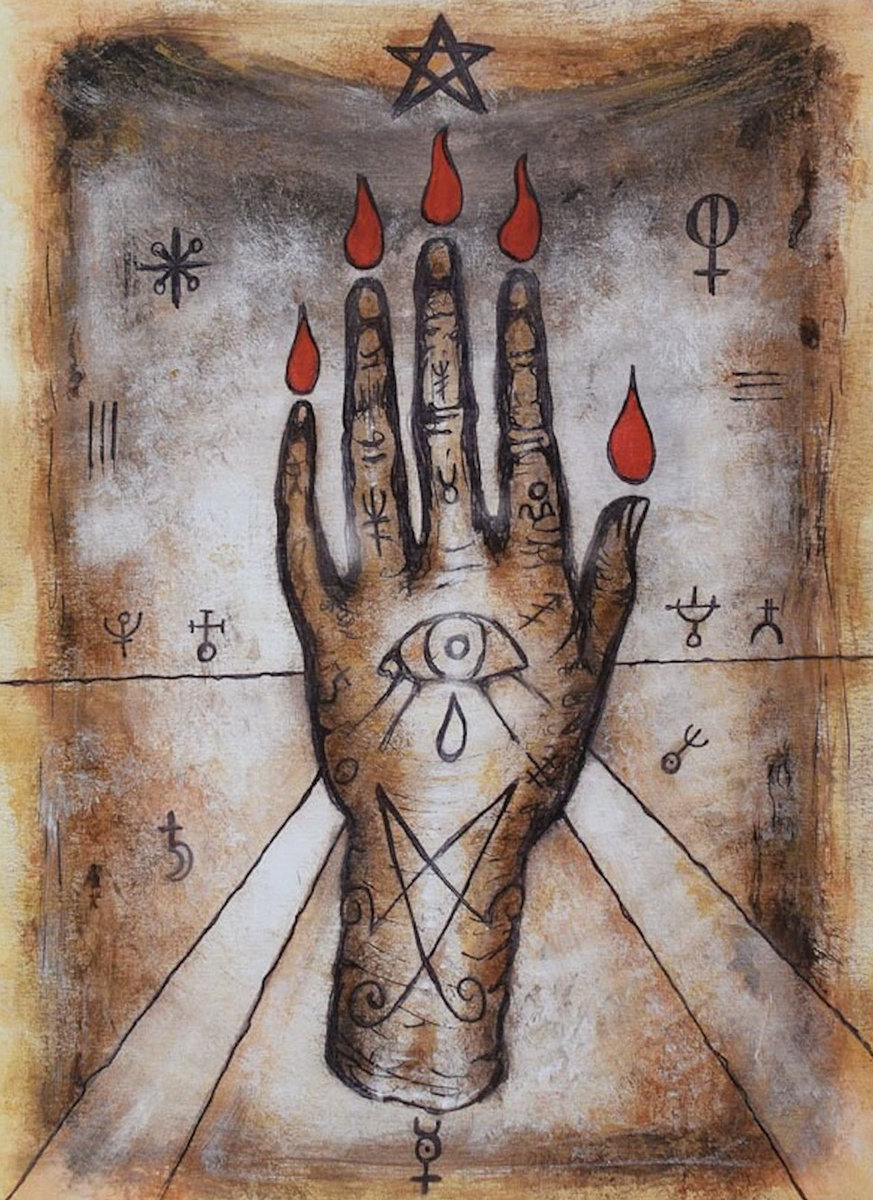 Dupuytren's contracture