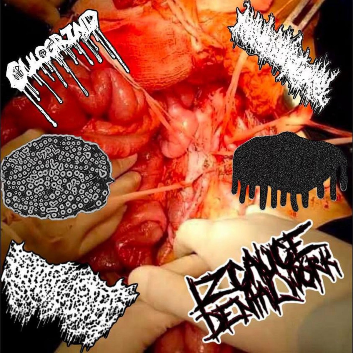 Intoxicated Adenomyosis (SIX WAY SPLIT)