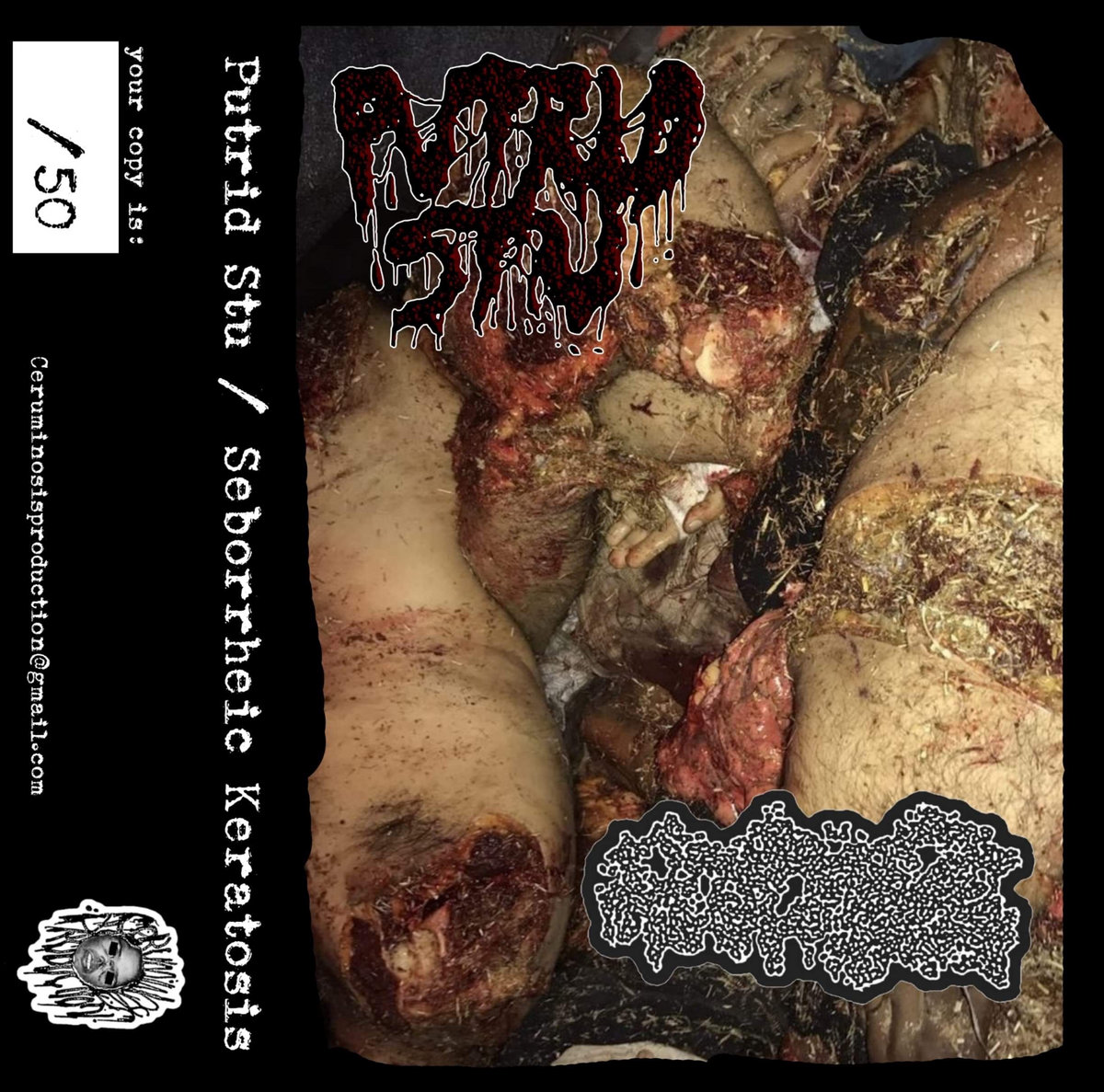 Split with Seborrheic Keratosis