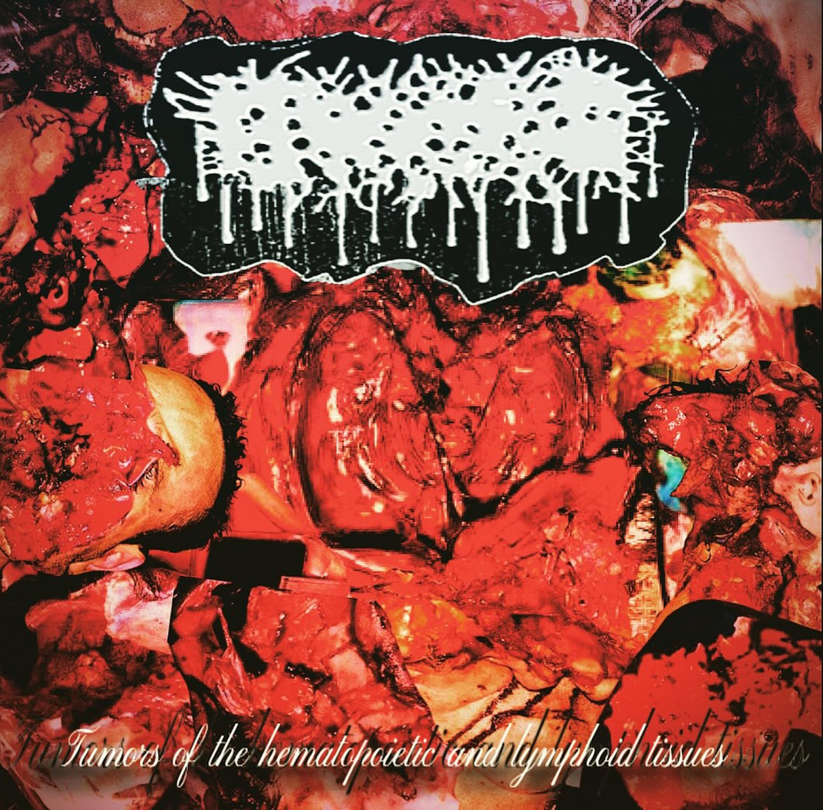 Tumors of the Hematopoietic and Lymphoid Tissues