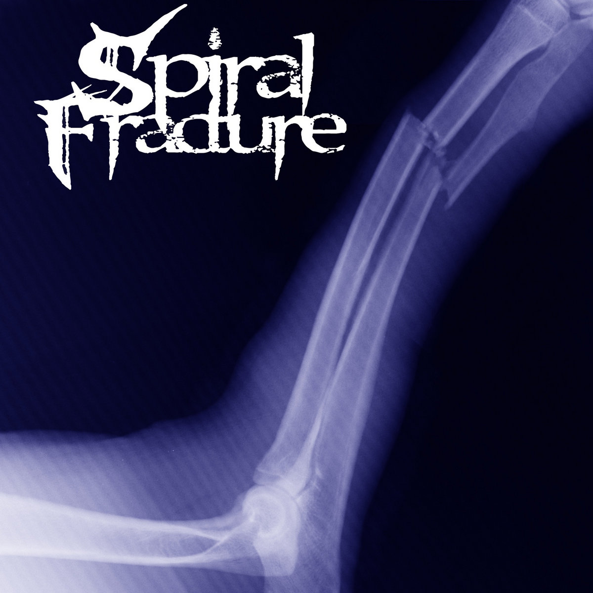 Spiral Fracture