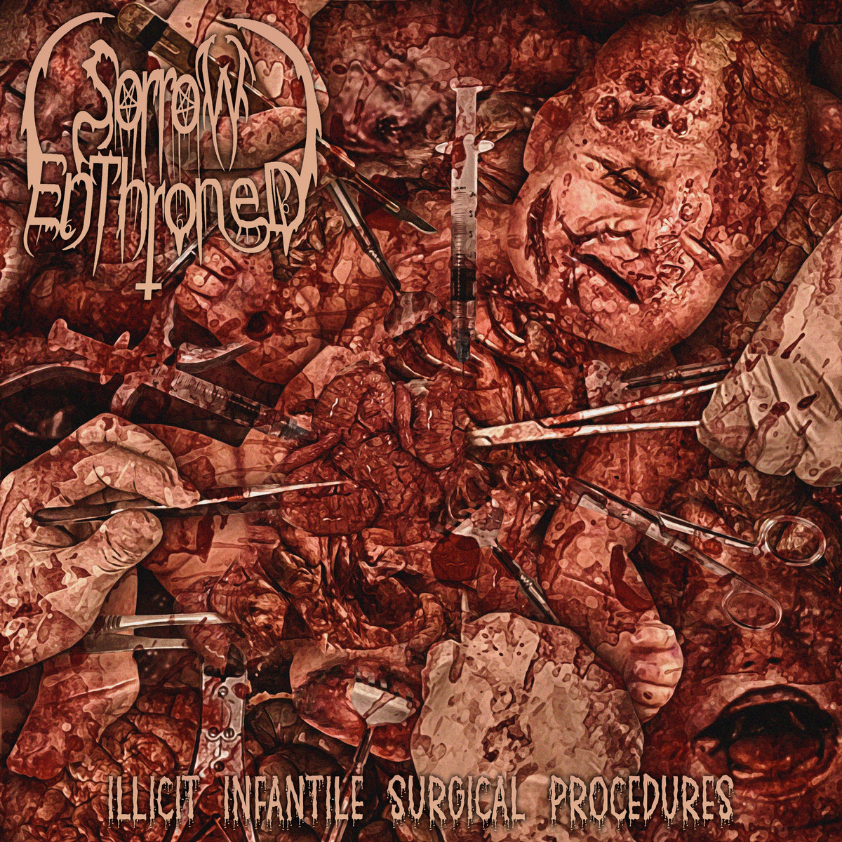 Illicit Infantile Surgical Procedures