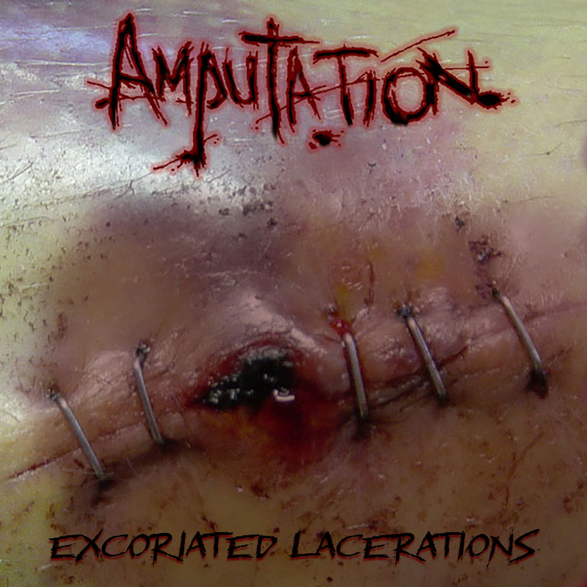 Excoriated Lacerations
