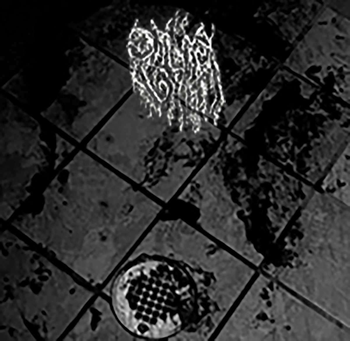 Vomiting Blood With Black Bile