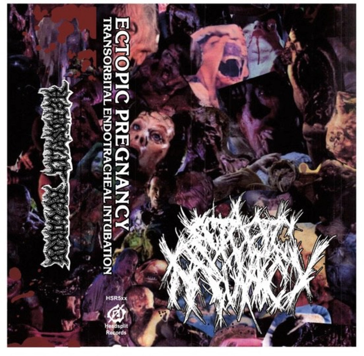 Transorbital Endotracheal Intubation